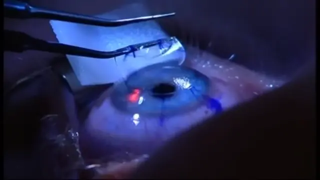 laser-eye-surgery-types-and-costs-guide-2026